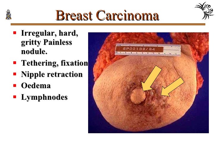 painless breast mass Painless breast mass